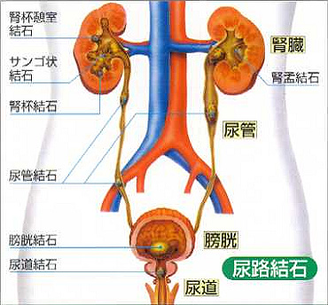 腰痛 腎臓 結石 腎臓結石を溶かす 3つの方法