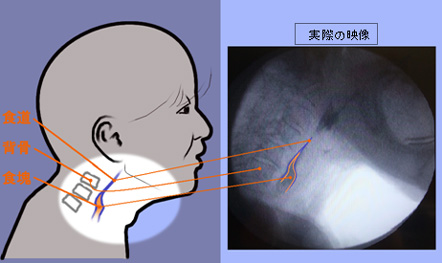 VF（嚥下造影検査）